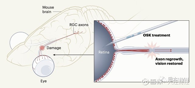 视觉新纪元，视神经再生最新技术的突破与展望
